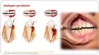 Fonte: https://www.google.com.br/search?q=curetas+de+gracey&espv=2&biw=1517&bih=735&tbm &
Fonte: http://profissaodentista.com/2015/08/10/sondagem-periodontal/
Sondagem periodontal
 