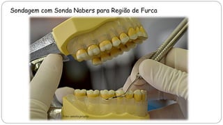 Sondagem com Sonda Nabers para Região de Furca
Foto: autoria própria
 