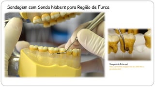 Sondagem com Sonda Nabers para Região de Furca
Imagem da Internet
http://perioclinic.blogspot.com.br/2009/06/o-
periodonto.html
 