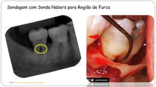 Fonte: http://www.inpn.com.br/Link-1410243
Sondagem com Sonda Nabers para Região de Furca
 