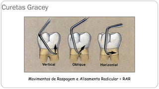 Curetas Gracey
Movimentos de Raspagem e Alisamento Radicular = RAR
 