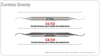 Curetas Gracey
Fonte: CURETAS GRACEY HU FRIEDY PADRAO - Dental Curitibana // http://loja.lojamaisfacil.com.br
 