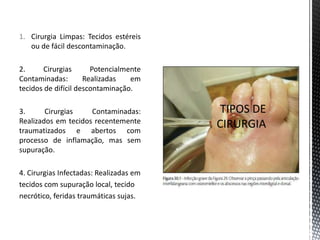 1. Cirurgia Limpas: Tecidos estéreis
ou de fácil descontaminação.
2. Cirurgias Potencialmente
Contaminadas: Realizadas em
tecidos de difícil descontaminação.
3. Cirurgias Contaminadas:
Realizados em tecidos recentemente
traumatizados e abertos com
processo de inflamação, mas sem
supuração.
4. Cirurgias Infectadas: Realizadas em
tecidos com supuração local, tecido
necrótico, feridas traumáticas sujas.
 