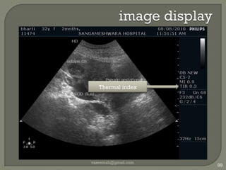 Image resolutionSpatial : 2 close objects as distinctAxial : along beam axisLateral : perpendicular to beam axisAzimuthal : perpendicular to beam & transducerContrast : two regions of different avg brightnessTemporal : distinguish events in timeReal time cant in cardiac valve motionFreedom from artifactsvaseemali@gmail.com91