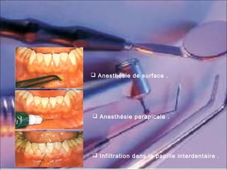  Anesthésie de surface .
 Anesthésie parapicale .
 Infiltration dans la papille interdentaire .
 