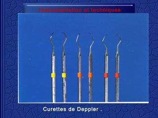 Instrumentation et techniques
Curettes de Deppler .
 
