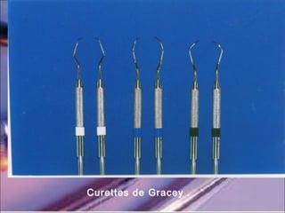 Curettes de Gracey .
 