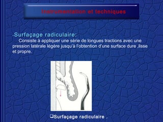 Instrumentation et techniques
-- Surfaçage radiculaire:Surfaçage radiculaire:
Consiste à appliquer une série de longues tractions avec une
pression latérale légère jusqu’à l’obtention d’une surface dure ,lisse
et propre.
Surfaçage radiculaire .
 