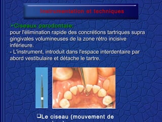 Ciseaux parodontale:Ciseaux parodontale:
pour l'élimination rapide des concrétions tartriques suprapour l'élimination rapide des concrétions tartriques supra
gingivales volumineuses de la zone rétro incisivegingivales volumineuses de la zone rétro incisive
inférieure.inférieure.
- L'instrument, introduit dans l'espace interdentaire par- L'instrument, introduit dans l'espace interdentaire par
abord vestibulaire et détache le tartre.abord vestibulaire et détache le tartre.
Instrumentation et techniques
Le ciseau (mouvement de
 