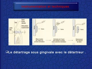 Instrumentation et techniques
Le détartrage sous gingivale avec le détartreur .
 