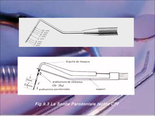 Fig.9.3 La Sonde Parodontale tactile CPI
 
