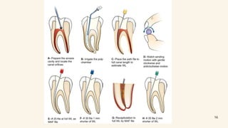Instrumentation of root canal system ppt | PPTX