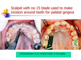 Scalpel with no 15 blade used to make
incision around teeth for palatal gingiva
Contraindication to do vertical incision in the palate
 