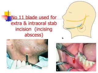 No 11 blade used for
extra & intraoral stab
incision (incising
abscess)
 