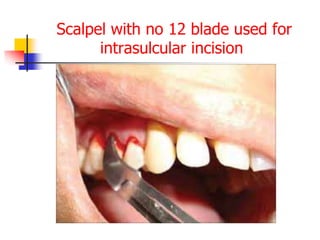 Scalpel with no 12 blade used for
intrasulcular incision
 