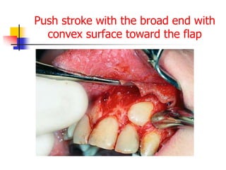 Push stroke with the broad end with
convex surface toward the flap
 