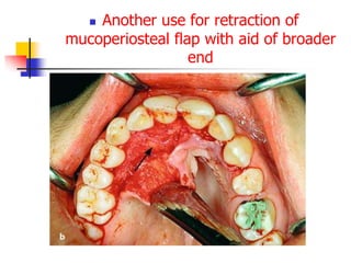  Another use for retraction of
mucoperiosteal flap with aid of broader
end
 