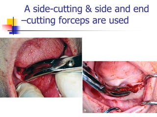 A side-cutting & side and end
–cutting forceps are used
 