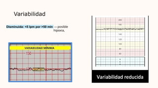 Variabilidad
Disminuida: <5 lpm por >50 min → posible
hipoxia,
 