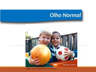 FÍSICA, 2º
Lentes Esféricas
Olho Normal
Imagem: Governo Federal dos EUA / Public Domain.
 