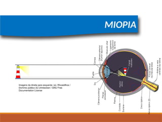 FÍSICA, 2º
Lentes Esféricas
Imagens da direita para esquerda: (a). Rhcastilhos /
Domínio público (b) Urinbecken / GNU Free
Documentation License
MIOPIA
 