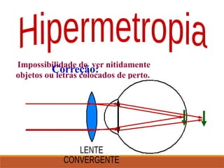 Impossibilidade de ver nitidamente
objetos ou letras colocados de perto.
Correção:
 