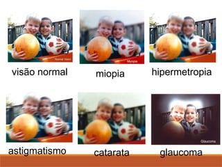 visão normal miopia hipermetropia
astigmatismo catarata glaucoma
 