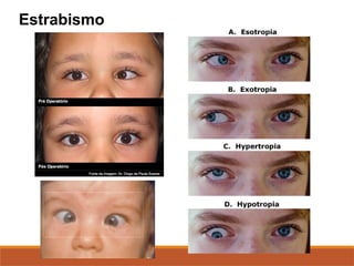 Estrabismo
 