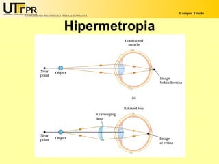 Campus Toledo
UNIVERSIDADE TECNOLÓGICA FEDERAL DO PARANÁ




                          Hipermetropia
 