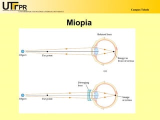 Campus Toledo
UNIVERSIDADE TECNOLÓGICA FEDERAL DO PARANÁ




                                             Miopia
 