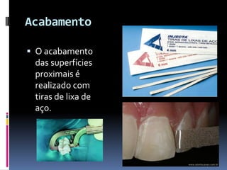 Acabamento

 O acabamento
 das superfícies
 proximais é
 realizado com
 tiras de lixa de
 aço.
 