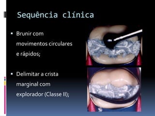Sequência clínica

 Brunir com
  movimentos circulares
  e rápidos;


 Delimitar a crista
  marginal com
  explorador (Classe II);
 