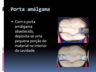Porta amálgama

 Com o porta
 amálgama
 abastecido,
 deposita-se uma
 pequena porção do
 material no interior
 da cavidade.
 