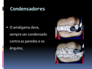 Condensadores


 O amálgama deve,
 sempre ser condensado
 contra as paredes e os
 ângulos;
 