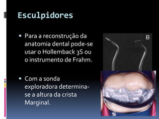 Esculpidores

 Para a reconstrução da
  anatomia dental pode-se
  usar o Hollemback 3S ou
  o instrumento de Frahm.

 Com a sonda
  exploradora determina-
  se a altura da crista
  Marginal.
 