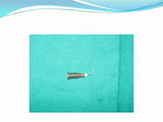 It is also called as bipolar dithermy as it has two poles and to the other side wire is attached.USES-It is used to cautery the bleeding episcleral vessels & conjunctival vessels after the conjunctival flap is made.