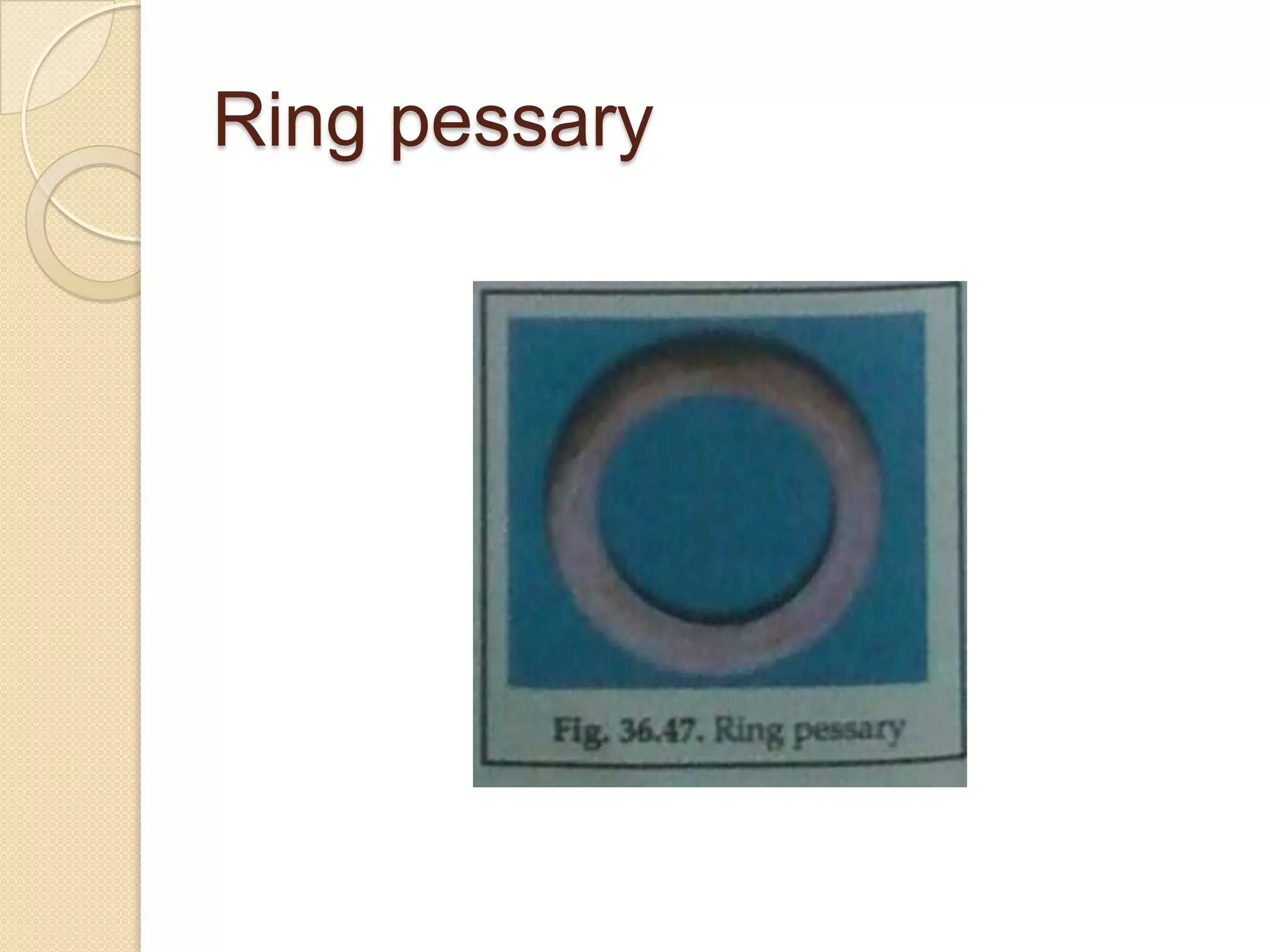 Ring pessary
 