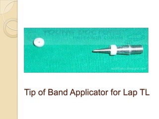 Tip of Band Applicator for Lap TL
 