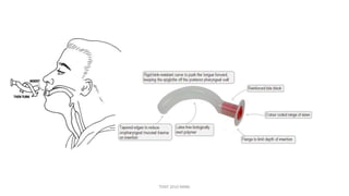 Guedel airway
• Prevent tongue from falling backwards
• Opening } aspiration
TONY 2010 MBBS
 