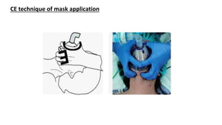 CE technique of mask application
 