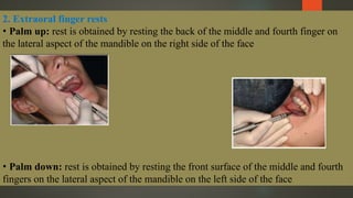 2. Extraoral finger rests
• Palm up: rest is obtained by resting the back of the middle and fourth finger on
the lateral aspect of the mandible on the right side of the face
• Palm down: rest is obtained by resting the front surface of the middle and fourth
fingers on the lateral aspect of the mandible on the left side of the face
 