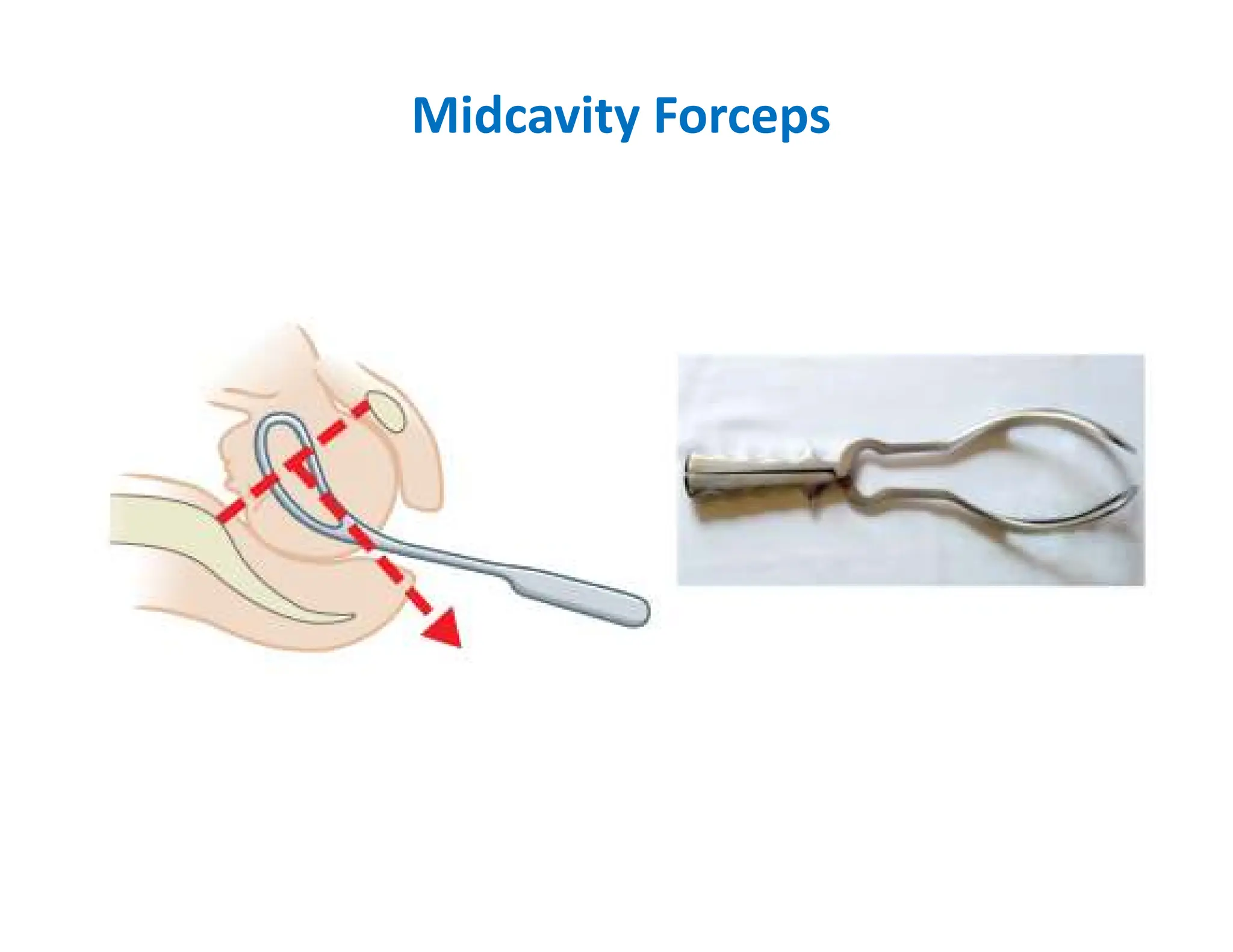 Midcavity Forceps
 