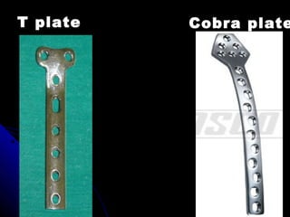 Cobra plateT plate
 