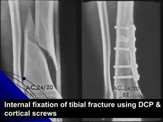 Internal fixation of tibial fracture using DCP &
cortical screws
 