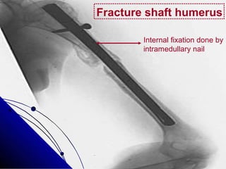 Fracture shaft humerus
Internal fixation done by
intramedullary nail
 