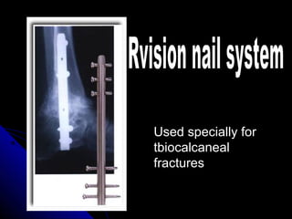 Used specially for
tbiocalcaneal
fractures
 