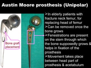 Austin Moore prosthesis (Unipolar)
In elderly patients with
fracture neck femur, for
replacing head of femur
Can be removed once the
bone grows
Fenestrations are present
on the stem through which
the bone supposedly grows &
helps in fixation of the
prosthesis
Movement takes place
between head part of
prosthesis & acetabulum
Bone graft
placement
 