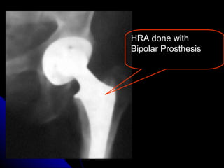 HRA done with
Bipolar Prosthesis
 