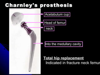 Charnley's prosthesis
Into the medullary cavity
neck
Head of femur
Acetabulum cup
Total hip replacement
Indicated in fracture neck femur
 