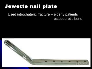 Jewette nail plate
Used introchateric fracture – elderly patients
- osteoporotic bone
 